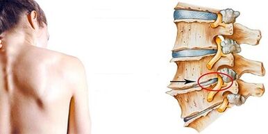El mecanismo de desarrollo de la osteocondosis cervical