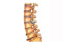 Fase de desarrollo de la osteocondosis cervical