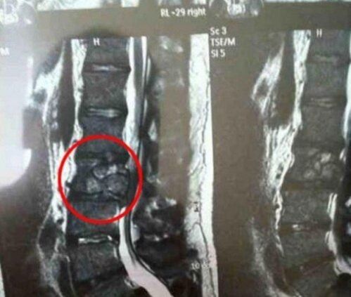 El tumor de la columna en la foto