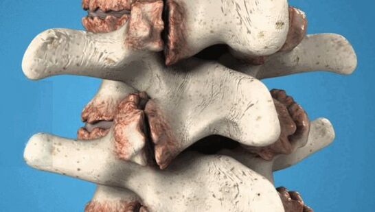 Osteofitos de las vértebras clases patológicas que dañan los nervios y los vasos sanguíneos