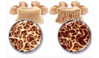 Peligro de aspiración cervical para las mujeres