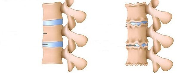 Columna vertebral sana y osteocondosa