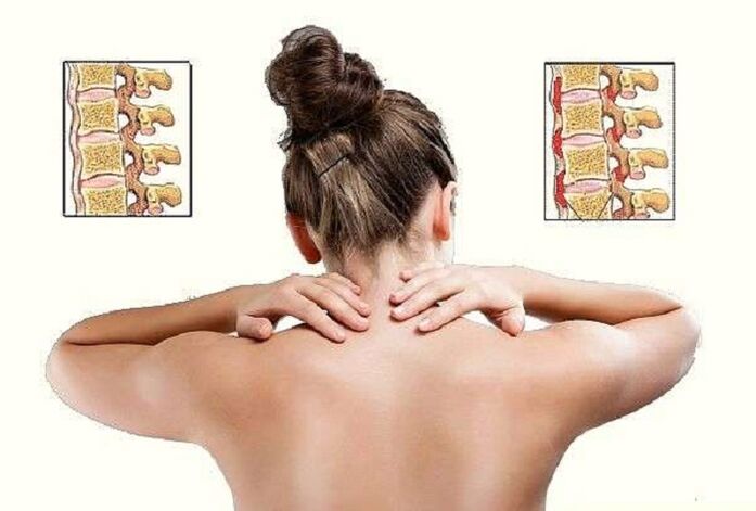 osteocondrosis cervical como causa de dolor debajo del omóplato izquierdo