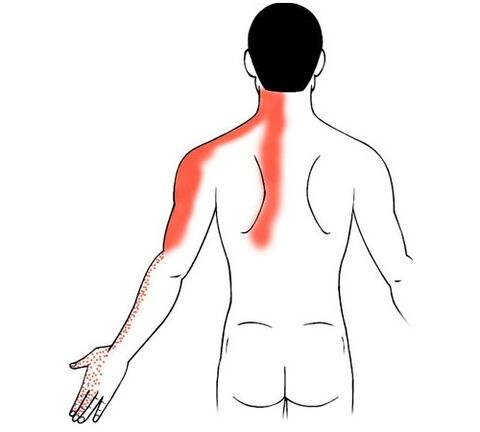 osteocondrosis cervical como causa de dolor en las articulaciones de los dedos