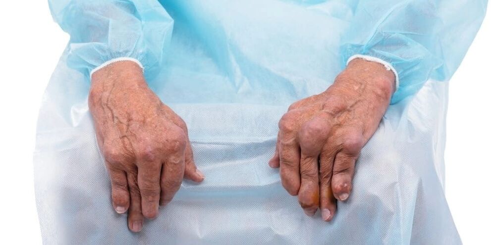 La artritis infecciosa es una enfermedad caracterizada por dolor constante y cambios en las articulaciones de los dedos.